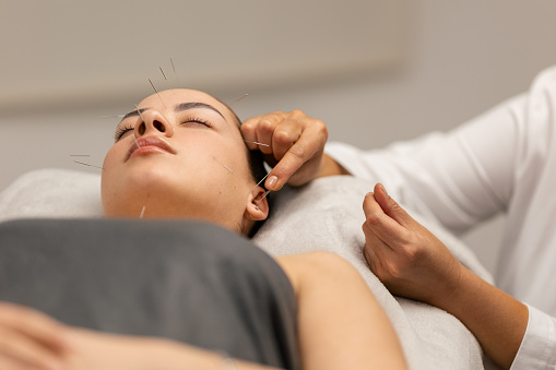 A young woman getting an acupuncture treatment on her head, ear and neck. She is lying in the therapist's office, the therapist is inserting acupuncture needles on her ear.