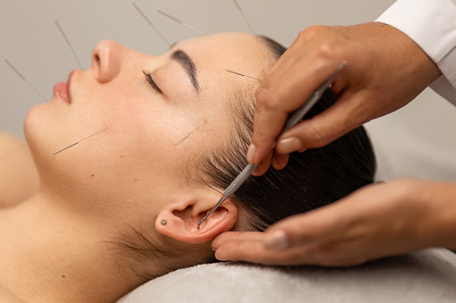 A young woman getting an acupuncture treatment on her head, ear and neck. She is lying in the therapist's office, the therapist is using tool for point pressure on her ear.