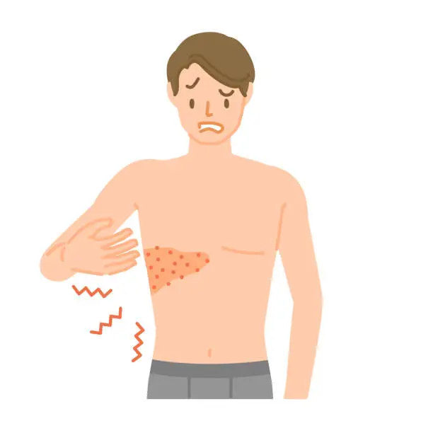 Vector illustration of Shingles: Men who experience pain, itching, and swelling from the chest to the back