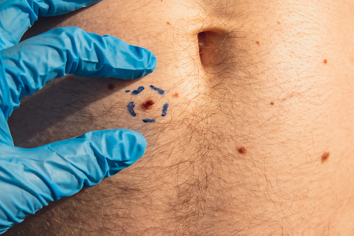 Preparing procedure for medical skin surgery. Unrecognizable Doctor in medical gloves paint lines around male birthmarks. Laser skin tags removal. Prevention of melanoma and nevus exam. Pigmentation