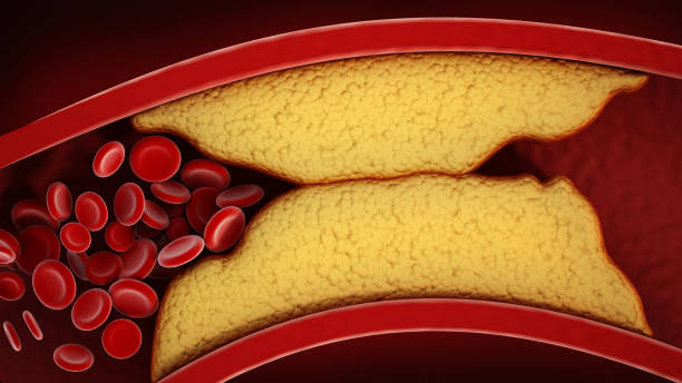 3D visualization of thickened arteries and veins, coronary heart disease This visualization showcases thickened arteries and veins, coronary heart disease. High cholesterrol blocks the vein preventing blood circulation within the vascular system. arterioles photos stock pictures, royalty-free photos & images