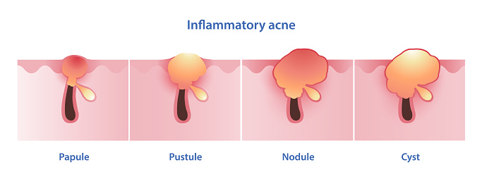 Diagram of inflammatory acne types vector illustration isolated on white background. Papule, pustule, nodule, nodular, nodulocystic, cystic acne and cyst. Skin care and beauty concept.