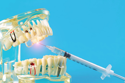 A syringe with an anesthetic anesthetic drug makes an injection into an inflamed tooth of a mock-up of a medical dental jaw on a blue background. Concept of dental treatment under anesthesia and freezing. Copy space for text