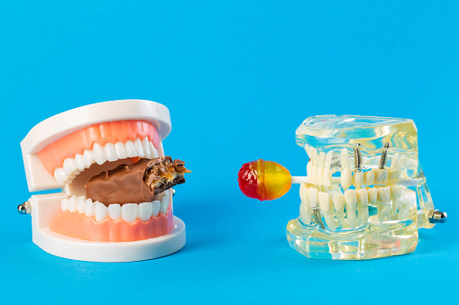 Two mock-ups of dental jaws with a lollipop and a chocolate bar on a blue background. The concept of the destructive effect on tooth enamel and teeth after eating sweets. Caries and pulpitis in children, bacteria. Oral hygiene, inflammation
