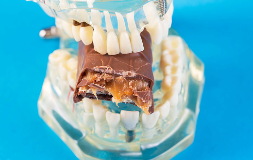 A bitten piece of chocolate in a dental jaw mockup on a blue background. The concept of the effect of sugar and leftover food on teeth and tooth enamel. Tooth destruction by bacteria, caries, pulpitis, close-up