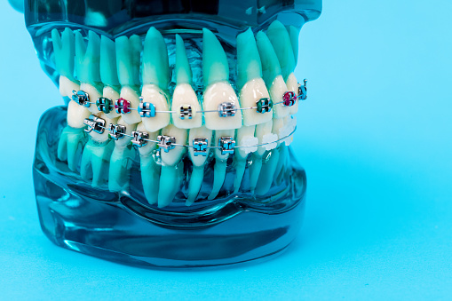 Orthodontic model on blue background.