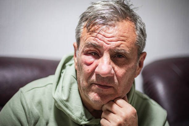 istock Human eye allergy, swollen eye 2121868638