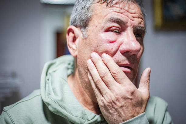 Red swollen male face, insect bite allergy