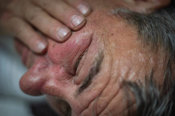 Red swollen eyelid on male face, insect bite allergy