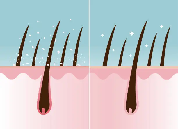 Vector illustration of 202403-Dandruff in hair