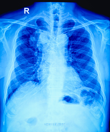 X-ray of the human chest. Sternotomy sutures were noted in situ. Suggestive of the right supra-hilar mass lesion (? bronchogenic growth or lymphadenopathy).