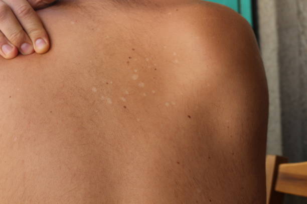istock Understanding Tinea Versicolor: Managing and Treating Pityriasis Versicolor 2123361254