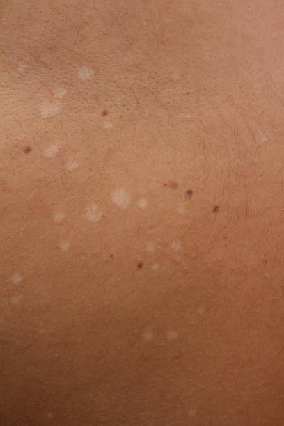 istock Understanding Tinea Versicolor: Managing and Treating Pityriasis Versicolor 2123361772