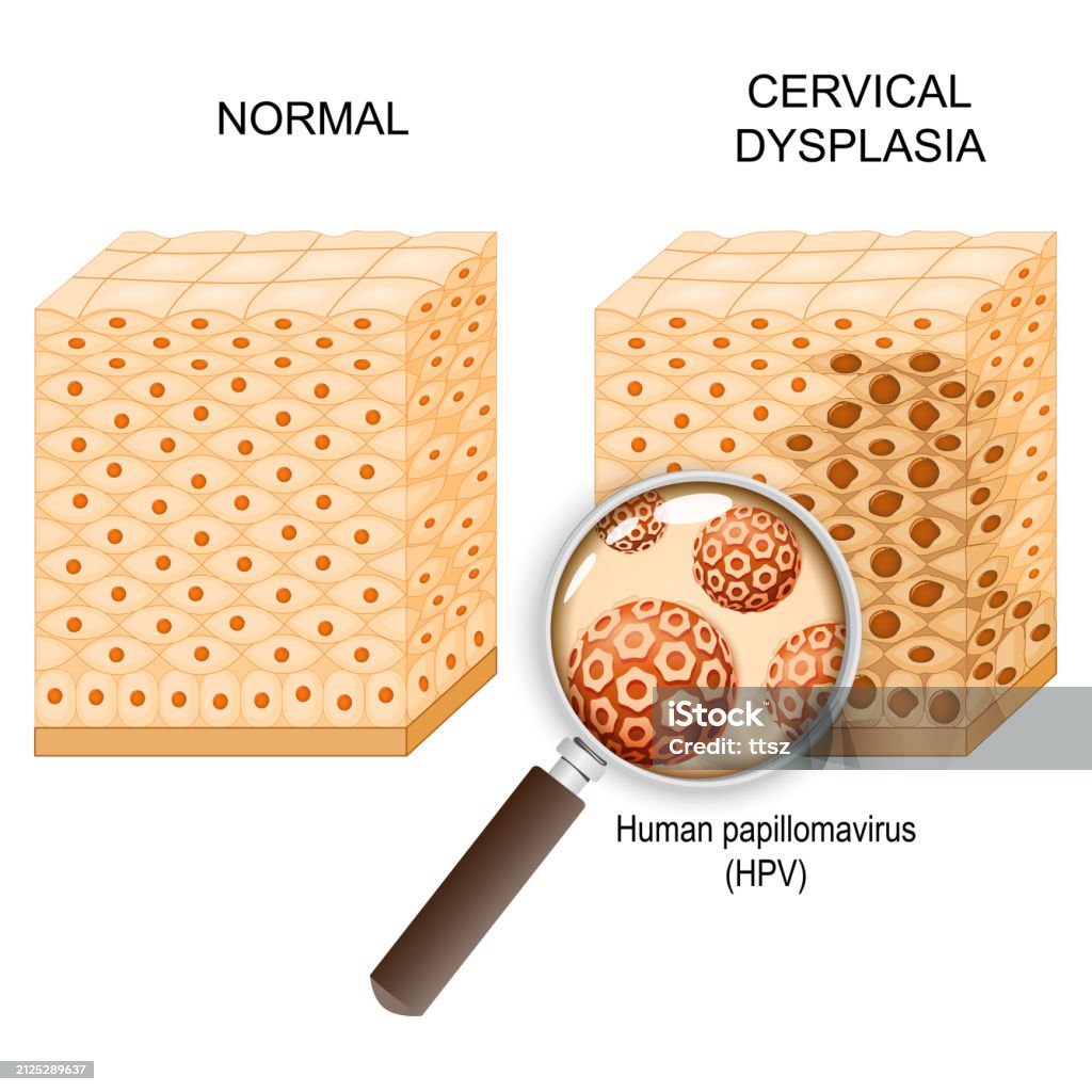 Cervical Dysplasia And Human Papillomavirus Infection Stock ...