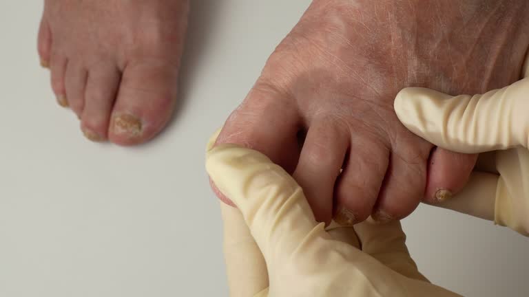 Toenail fungus. Nails affected by a fungal infection. Onycholysis of nails, paramedicine, medical pedicure, aging problems