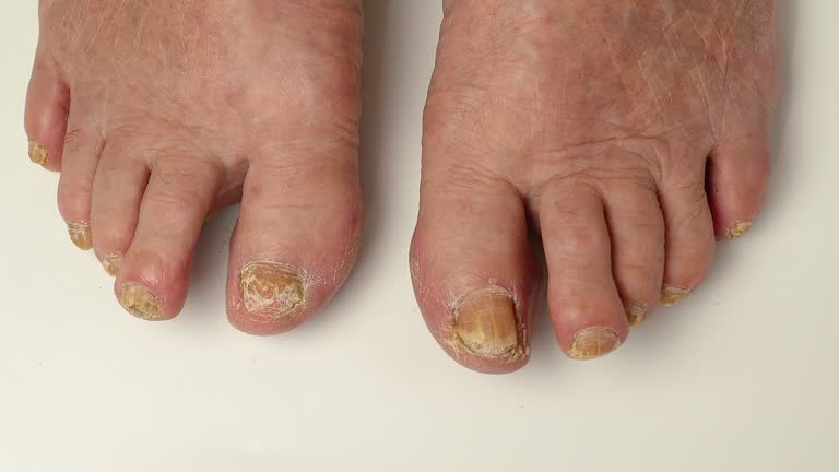 Toenail fungus. Nails affected by a fungal infection. Onycholysis of nails, paramedicine, medical pedicure, aging problems