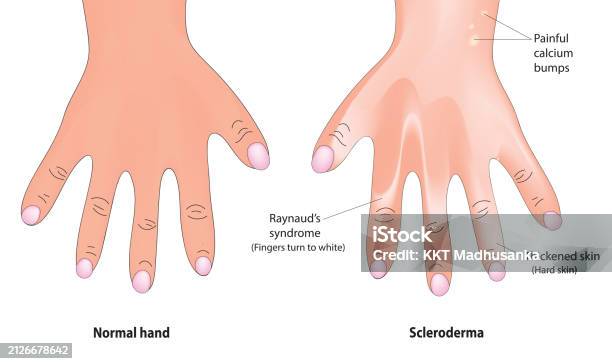 Shiny Fingertips Scleroderma On The Hand Stock Illustration - Download Image Now - Adult ...