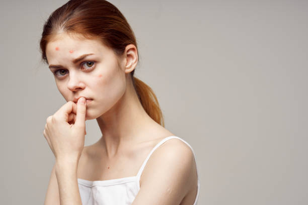 istock woman face skin problem acne acne portrait cropped view 2127057992