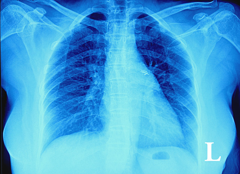 X-ray of the human chest. Report: Fracture is noted at right 2nd rib. Abnormality detected.