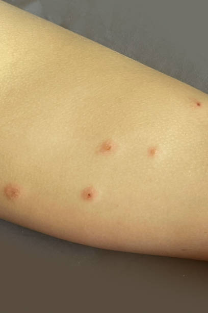 istock Bedbug bites on skin. Human leg close up 2128784031
