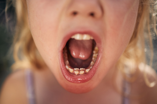 Close up of girls mouth with shark bite dental problem.