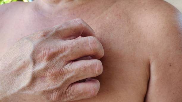 istock The rash hives blackhead and allergy. 2129839646