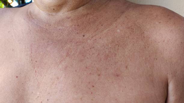 istock The rash hives blackhead and allergy. 2129839670