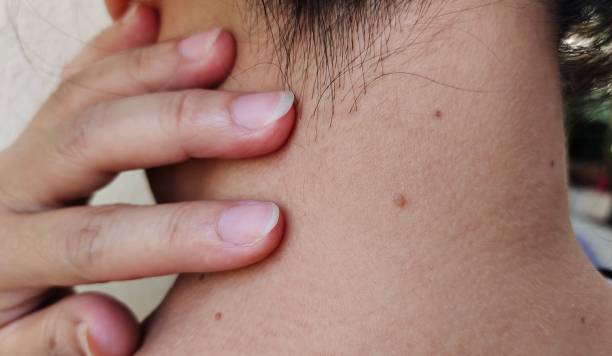 istock The fleck and mole on the neck. 2129844393
