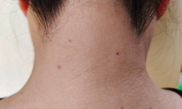 istock The fleck and mole on the neck. 2129845274