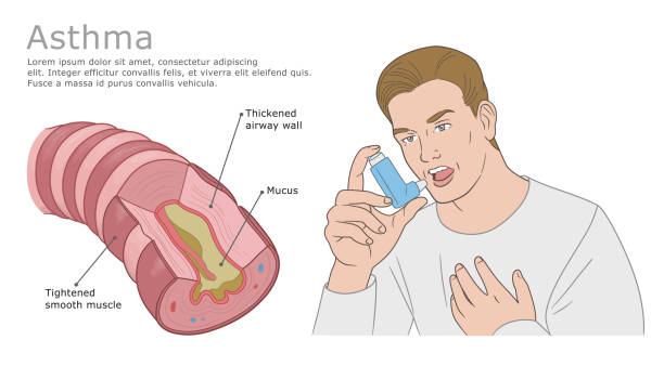 ilustrações, clipart, desenhos animados e ícones de ilustração da asma com bronquíolo asmático e homem com inalador - inhaling human lung problems anatomy