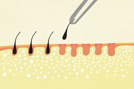 Detailed cross-section illustration of human hair follicle structure in the epidermis and dermis layers of the skin for medical, educational, and dermatology purposes