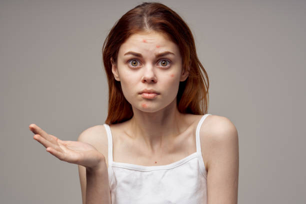 istock woman with pimple on her face acne health problems white tshirt 2131277039