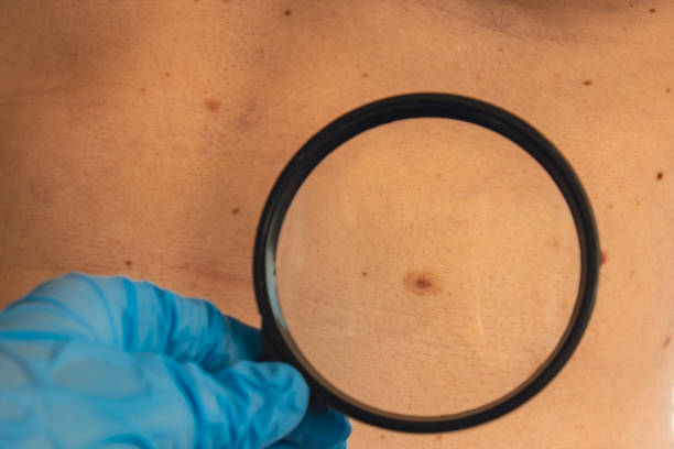 istock Mole dermoscopy, preventive of melanoma. Dermatologist examining patient's birthmark with magnifying glass in clinic. Checking benign moles. Skin abnormalities care 2132152479
