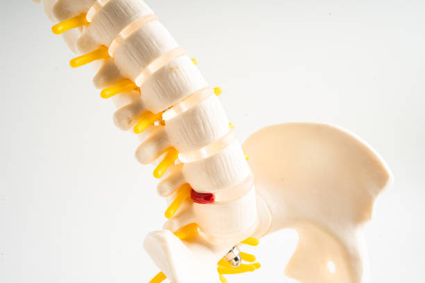 lumbar spine displaced herniated disc fragment, spinal nerve and bone. model for treatment medical in the orthopedic department. - slipped disc fotografías e imágenes de stock