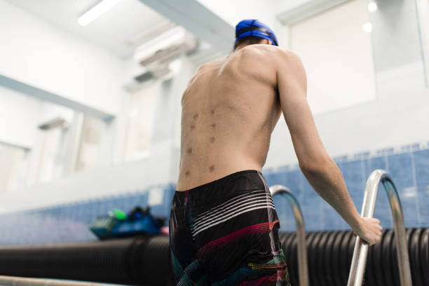 Young man with scars from invasive medical procedure on his back  due to an accident is getting out from the swimming pool after his rehabilitation procedure.