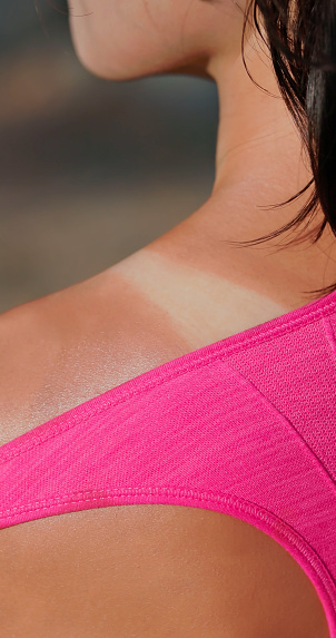 closeup asian young woman standing outdoors - she got sunburn marks and hurt on shoulder of sports bra strap