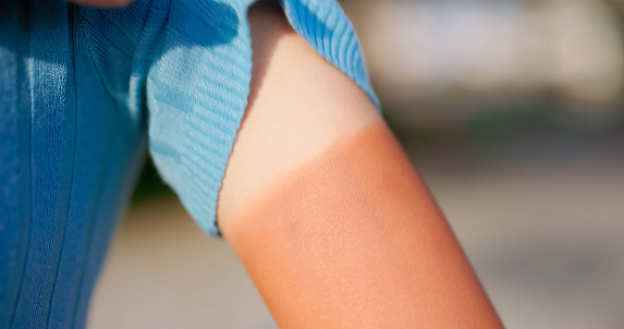 Closeup asian young woman got sunburned arms with tan line