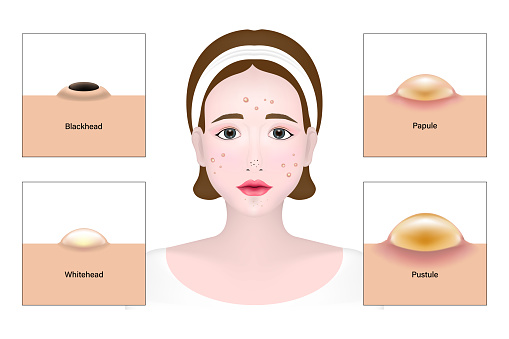 Women and types of acne, Skin problems vector, Blackhead, Whitehead, Papule, Pustule