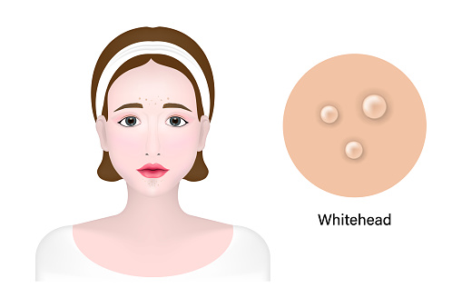 Women and whitehead acne, Skin problem vector