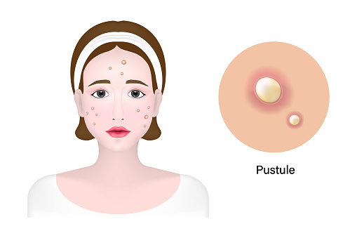 Women and pustule acne, Skin problem vector