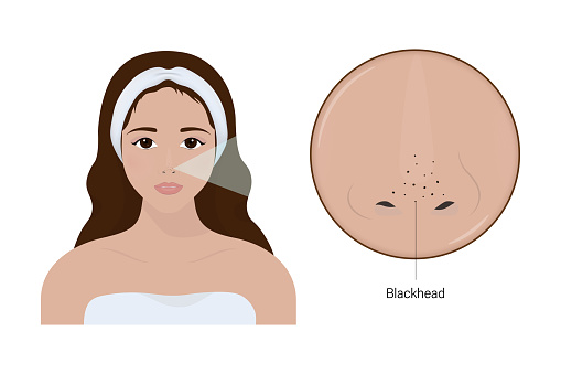 Woman with acne and a close up enlarged image of the facial skin showing blackheads.
Acne problem. Comedones. Vector for cosmetic and beauty advertising.