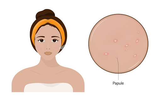 Woman with acne and a close up enlarged image of the facial skin showing papules.
Acne problem. Vector for cosmetic and beauty advertising.