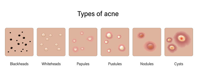 Types of acne skin vector. Blackheads, Whiteheads, Papules, Pustules, Nodules and Cysts.