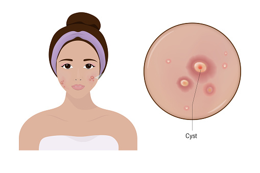 Woman with acne and a close up enlarged image of the facial skin showing cystics.
Acne problem. Vector for cosmetic and beauty advertising.