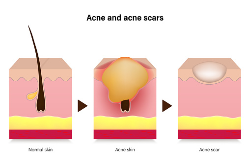 Acne. Diagram of normal skin, acne skin and acne scar. Vector for advertising about beauty and medical treatment.