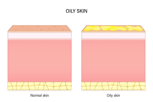 Oily skin. Comparison of normal and oily skin. Facial skin problems. Vector for advertising about beauty and medical treatment.
