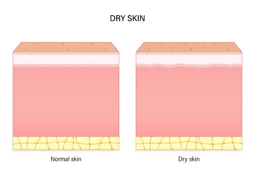 Dry skin. Comparison of normal and dry skin. Facial skin problems. Vector for advertising about beauty and medical treatment.