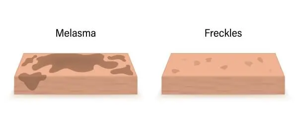 Vector illustration of The difference between skin with melasma and skin with freckles. Human skin layer anatomy vector.