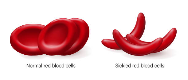 ilustraciones, imágenes clip art, dibujos animados e iconos de stock de sickle cell disease. normal red blood cells and sickled red blood cells. - sickle cell anemia red blood cell blood cell anemia