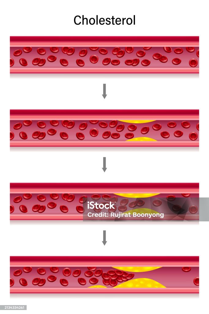 Cholesterol In Blood Vessels Atherosclerosis Clogged Arteries Caused By